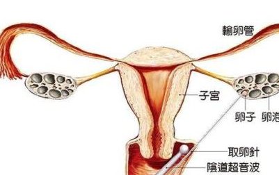 泰国三代试管婴儿分娩成功率解析